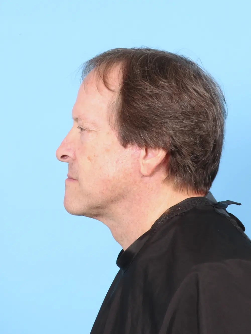 Facelift / Neck Lift Patient Photo - Case 55255 - after view-2