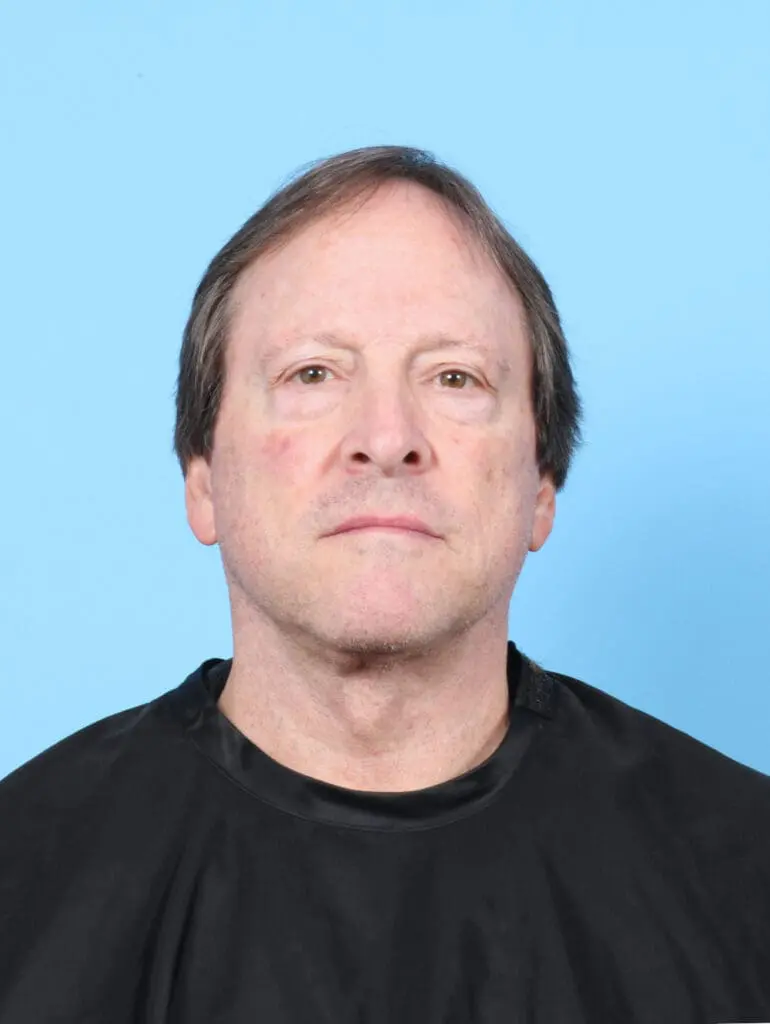 Facelift / Neck Lift - Case 55255 - After