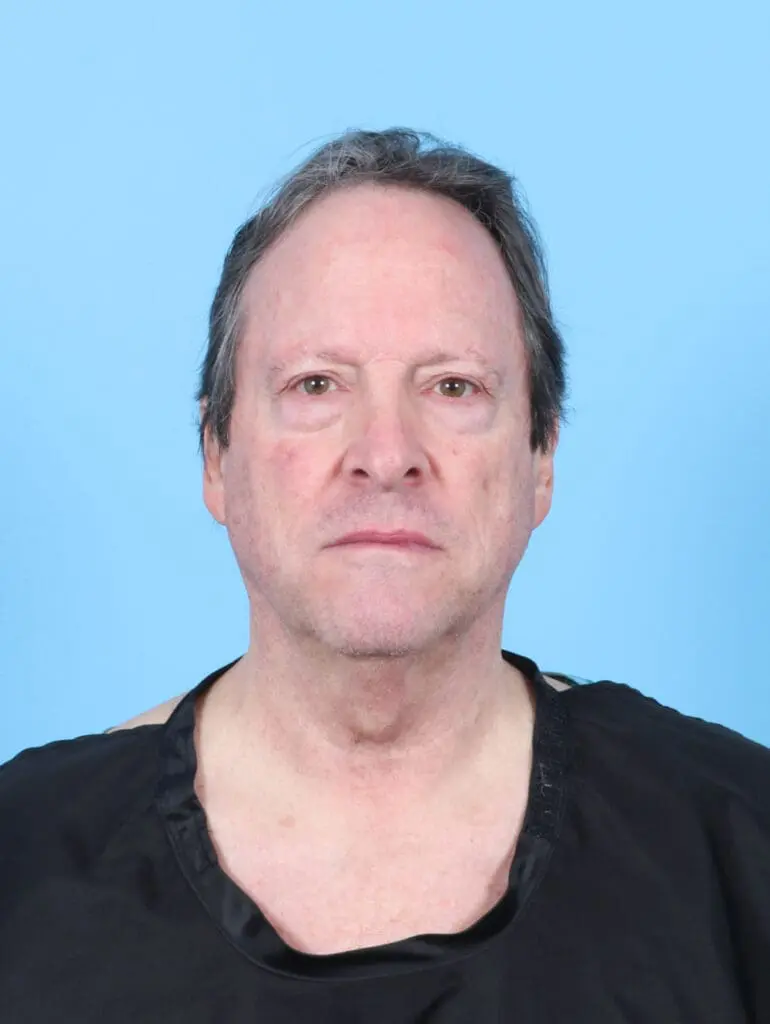 Facelift / Neck Lift - Case 55255 - Before