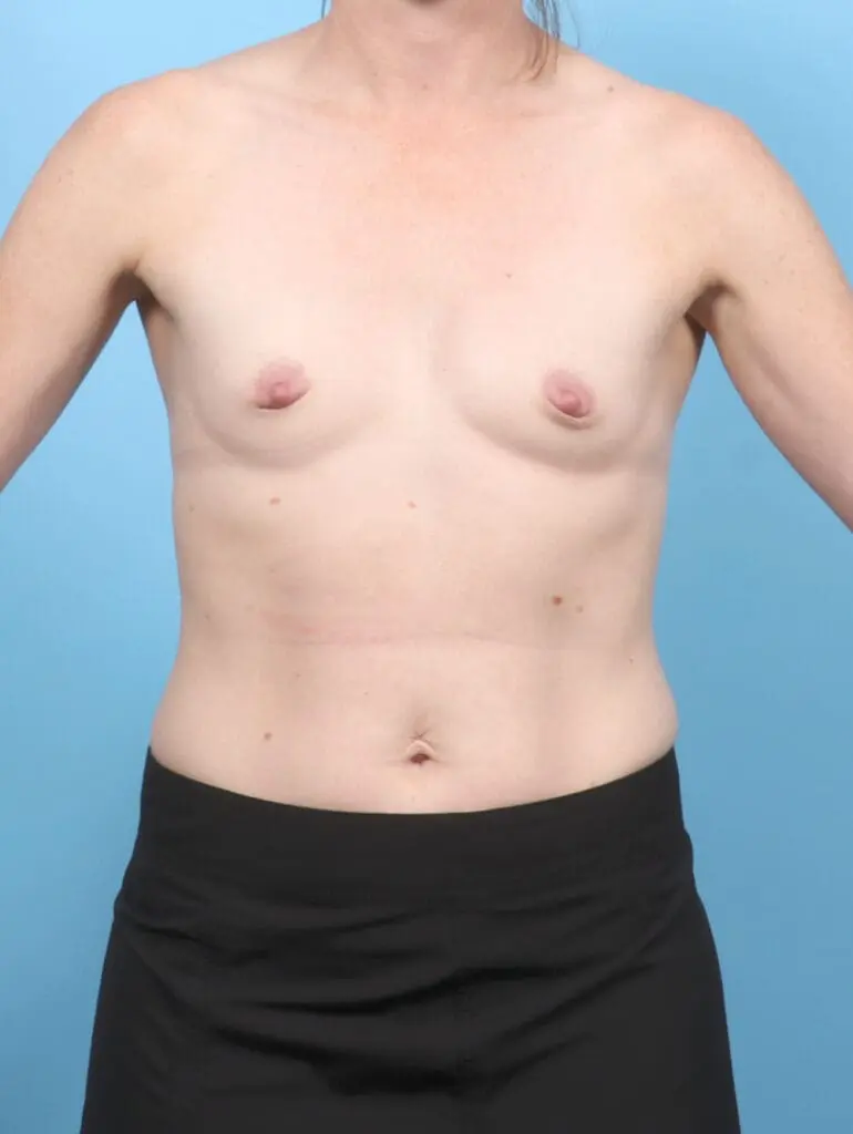 Breast Augmentation - Case 55298 - Before