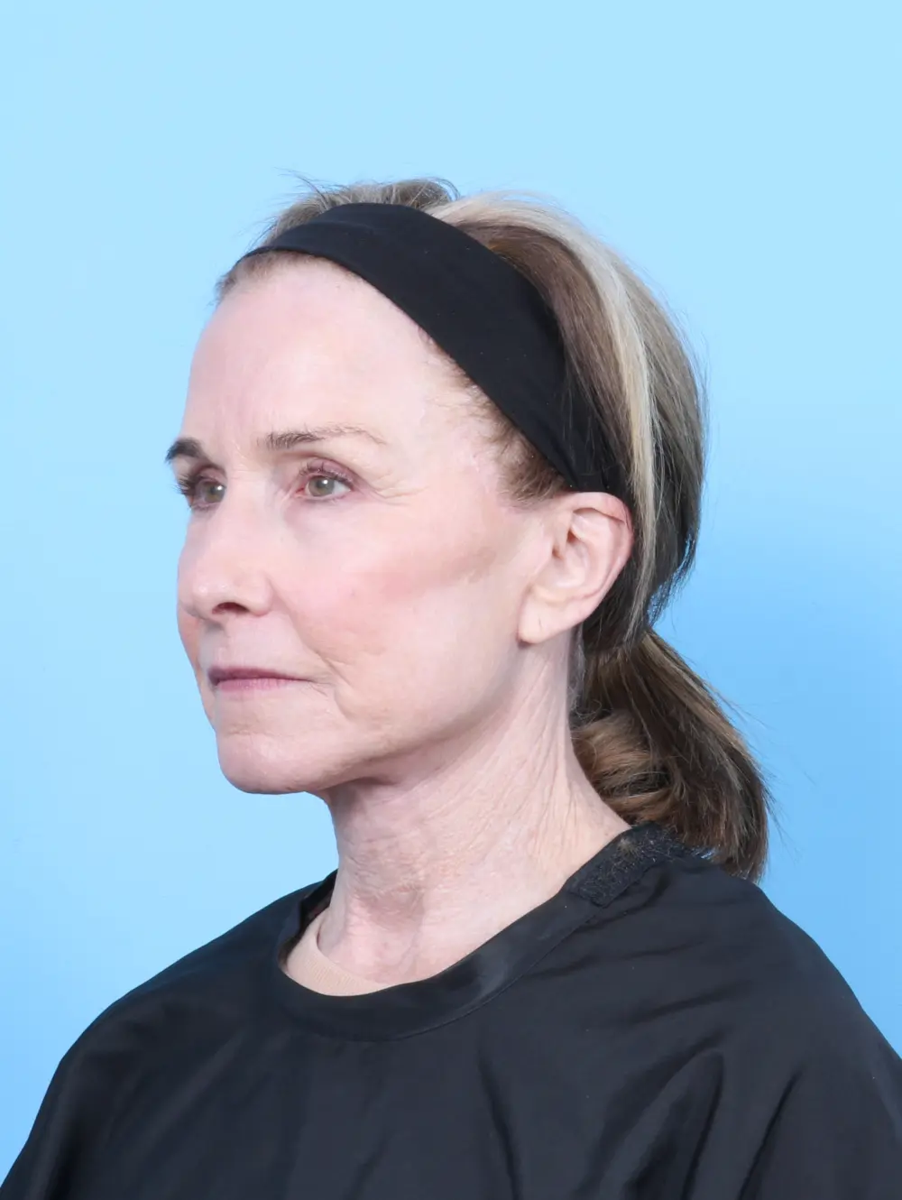 Facelift / Neck Lift Patient Photo - Case 55306 - after view-1