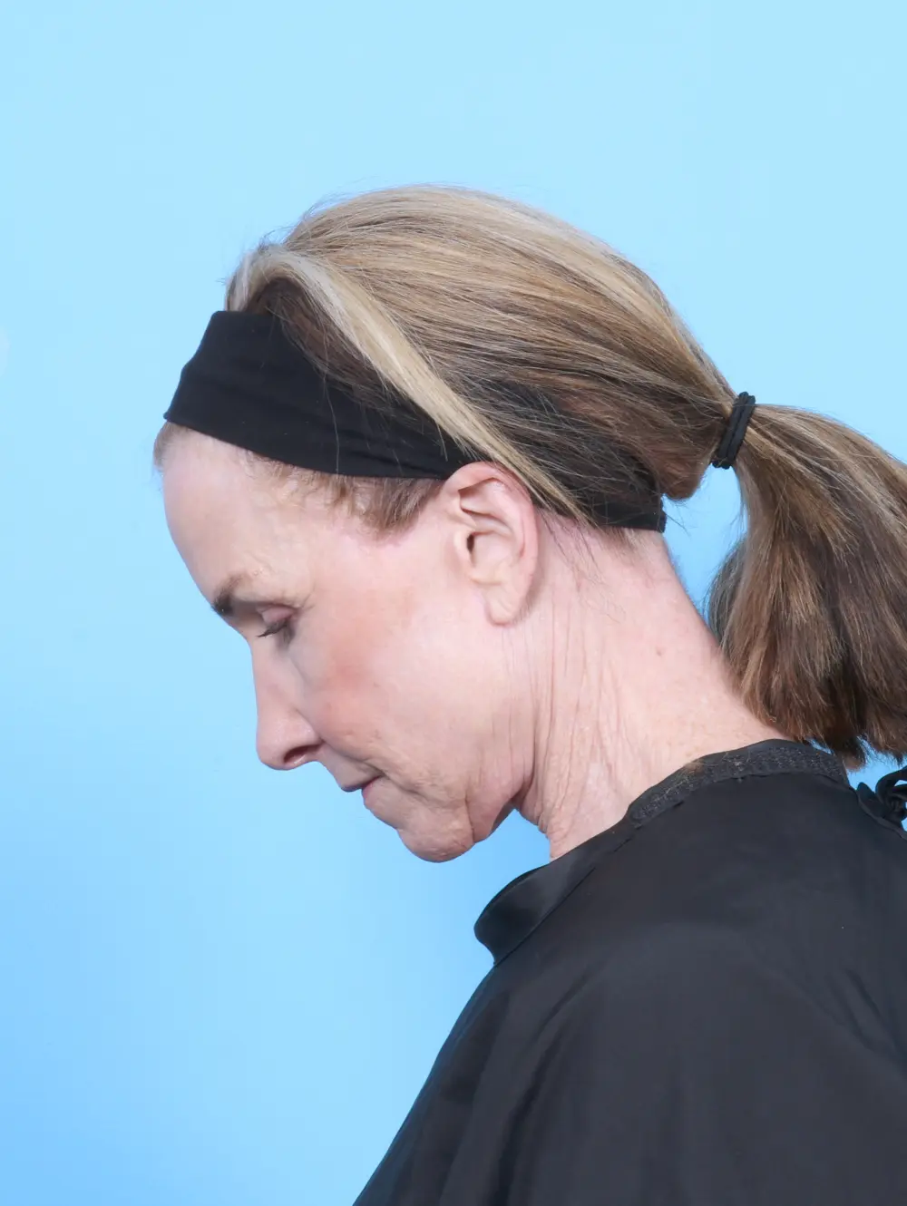 Facelift / Neck Lift Patient Photo - Case 55306 - after view-3