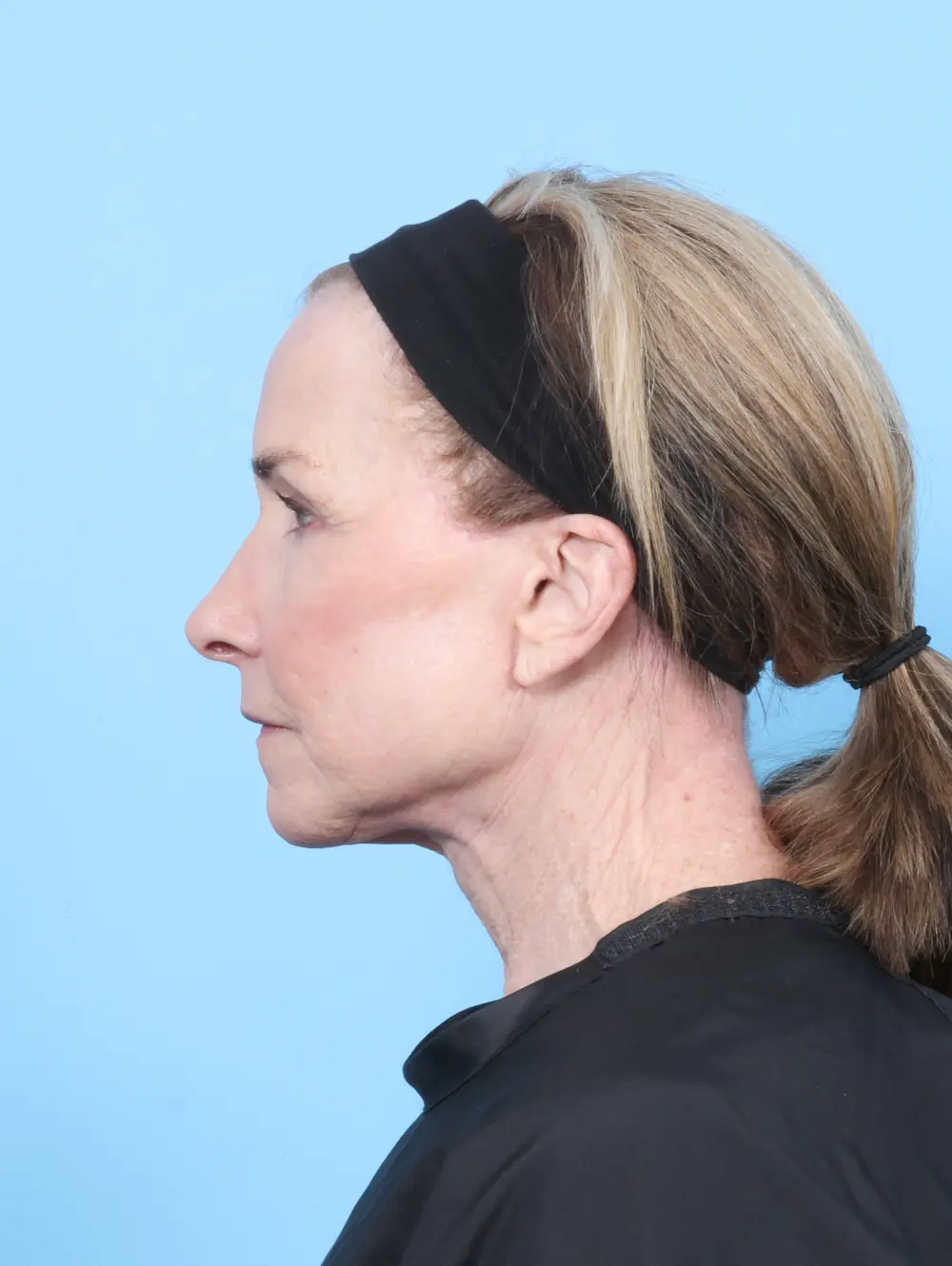 Facelift / Neck Lift Patient Photo - Case 55306 - after view-2