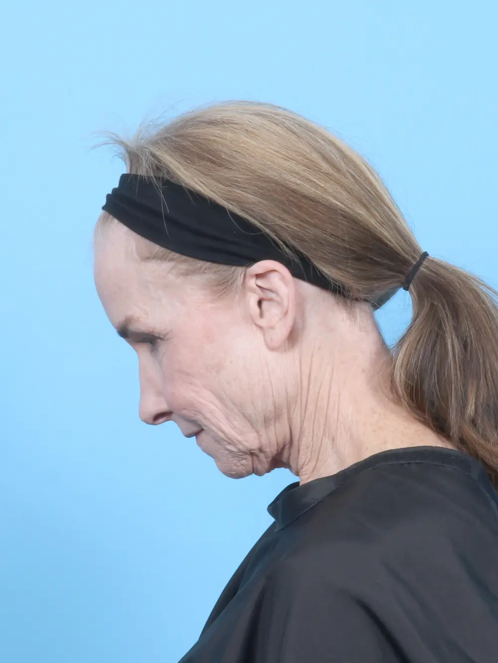 Facelift / Neck Lift Patient Photo - Case 55306 - before view-3