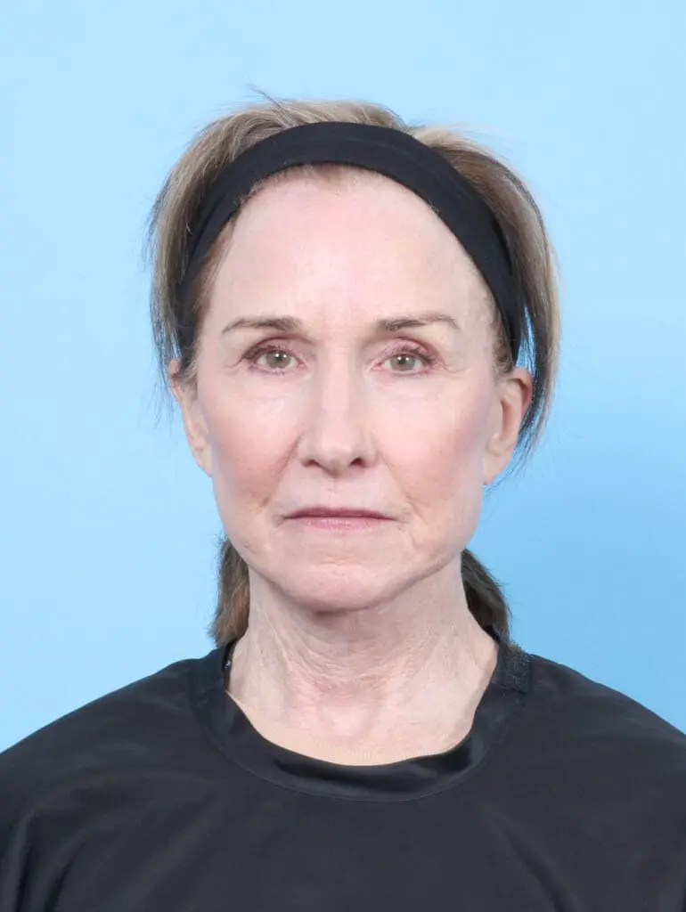 Facelift / Neck Lift - Case 55306 - After