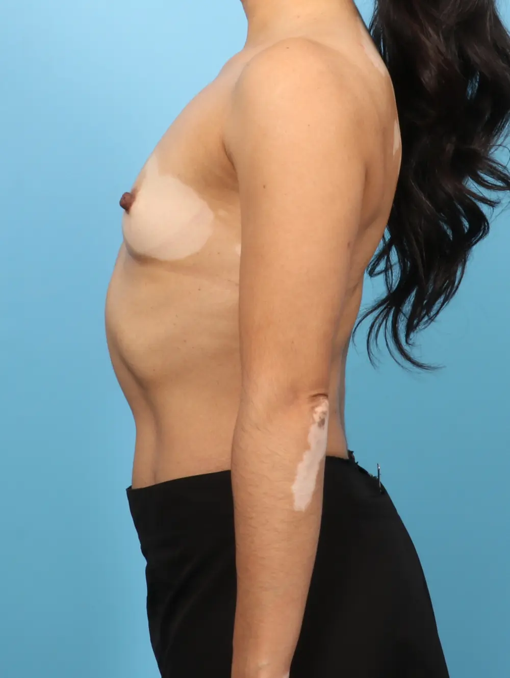 Breast Augmentation Patient Photo - Case 55341 - before view-2