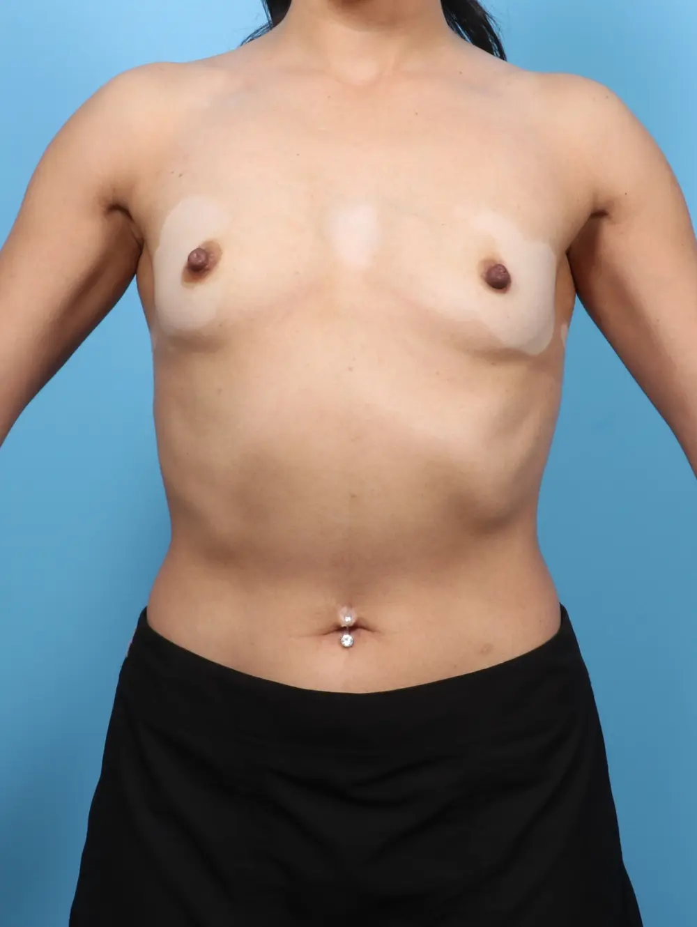 Breast Augmentation Patient Photo - Case 55341 - before view-