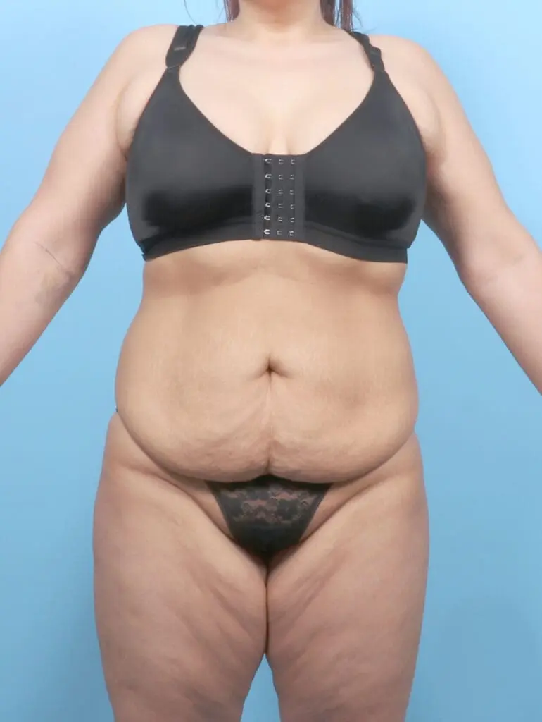 Tummy Tuck - Case 55358 - Before