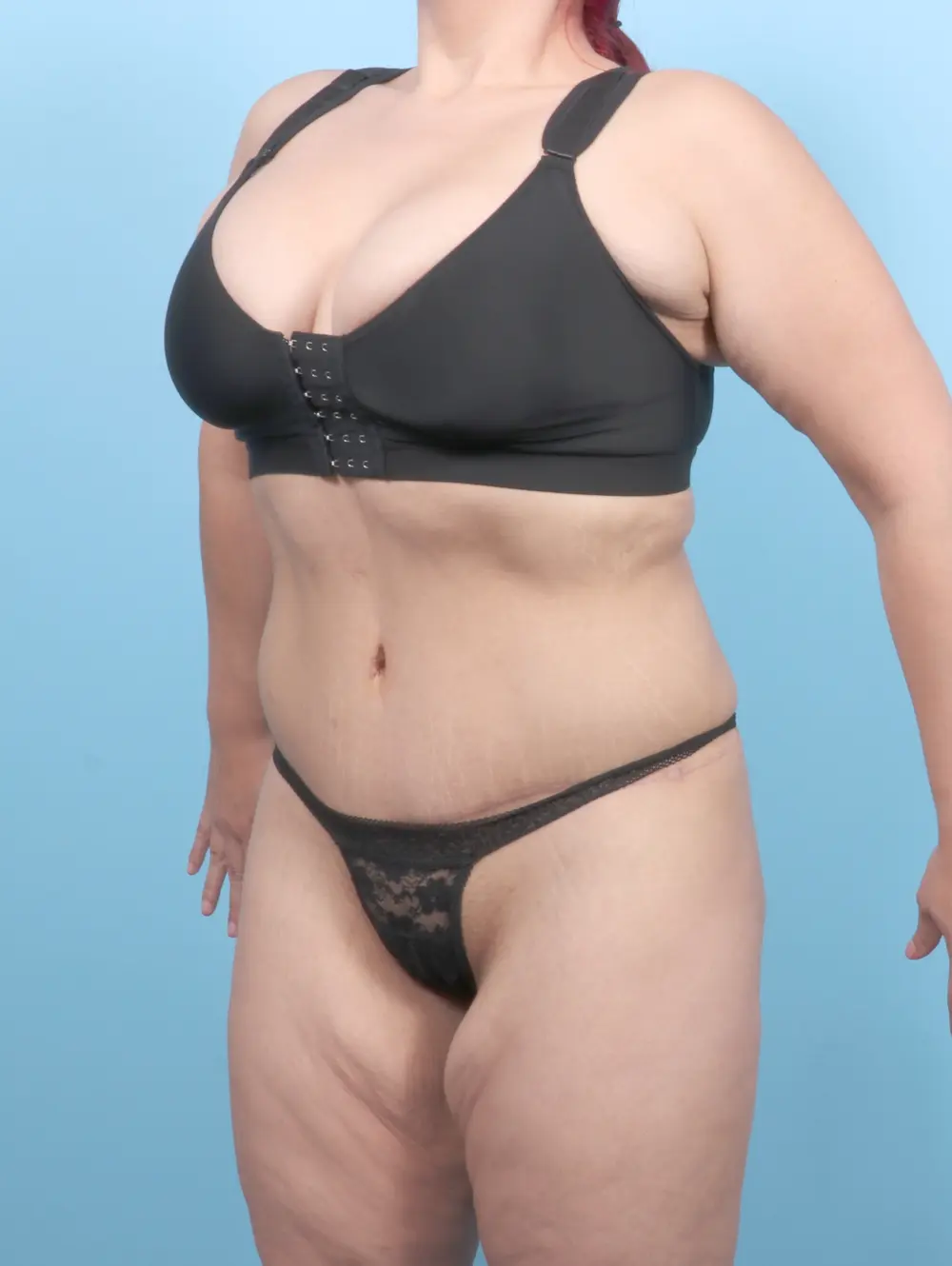 Tummy Tuck Patient Photo - Case 55358 - after view-1