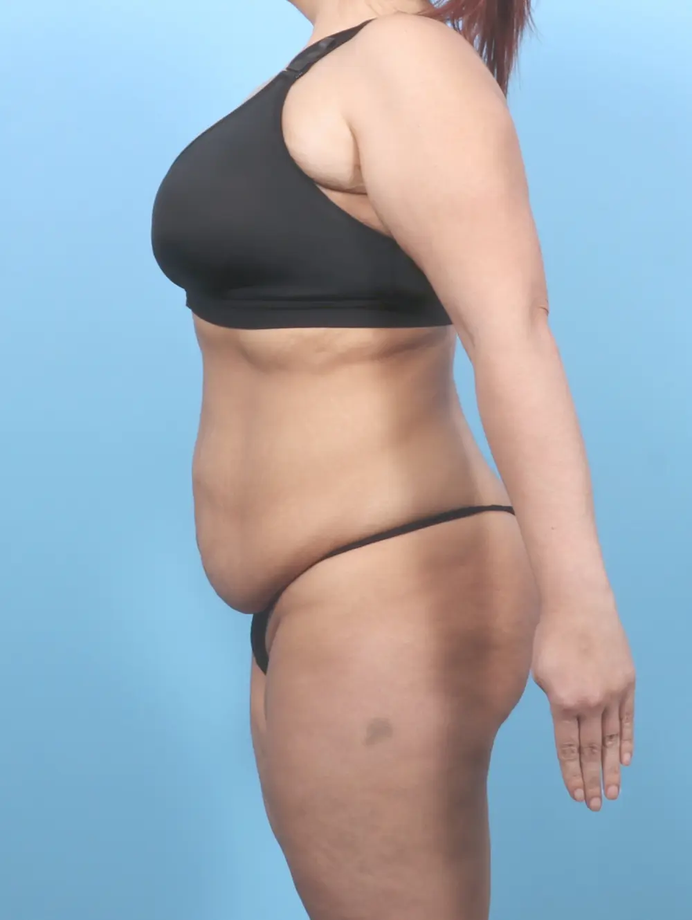 Tummy Tuck Patient Photo - Case 55358 - before view-2