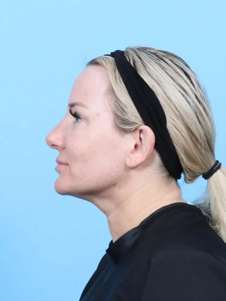 Rhinoplasty - Case 55368 - After