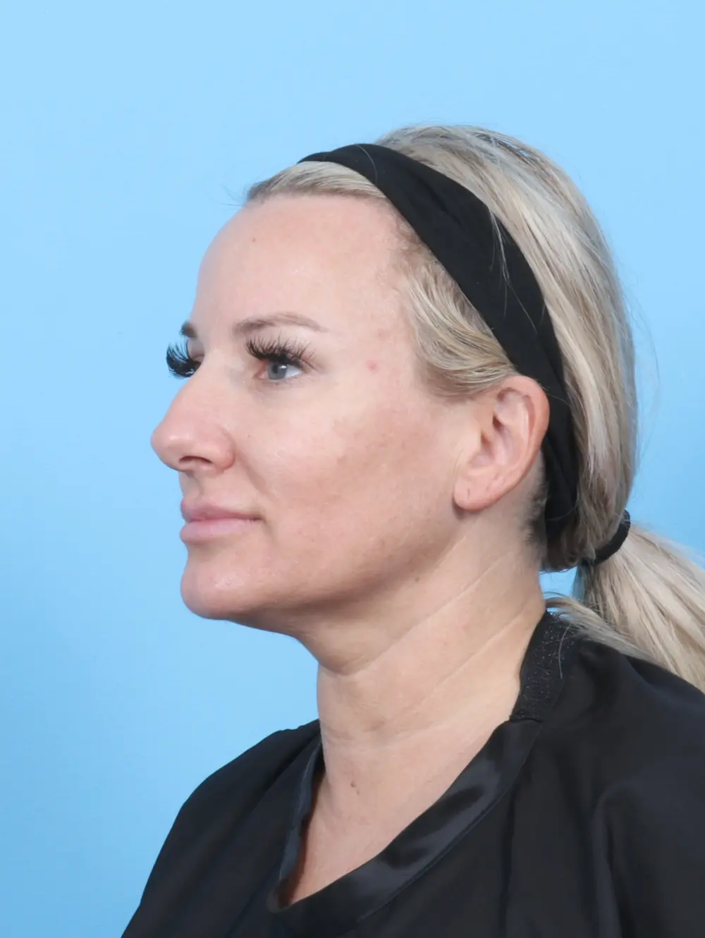Rhinoplasty Patient Photo - Case 55368 - before view-1