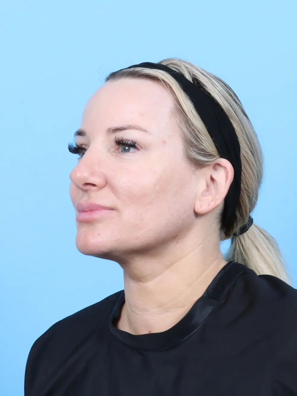 Rhinoplasty Patient Photo - Case 55368 - after view-1