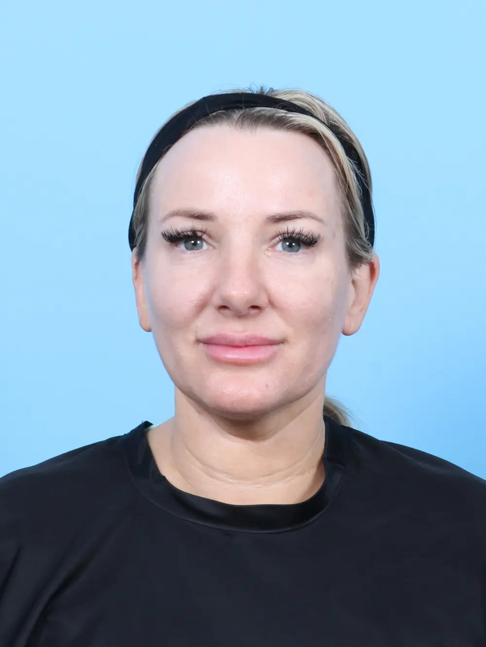 Rhinoplasty Patient Photo - Case 55368 - after view-2