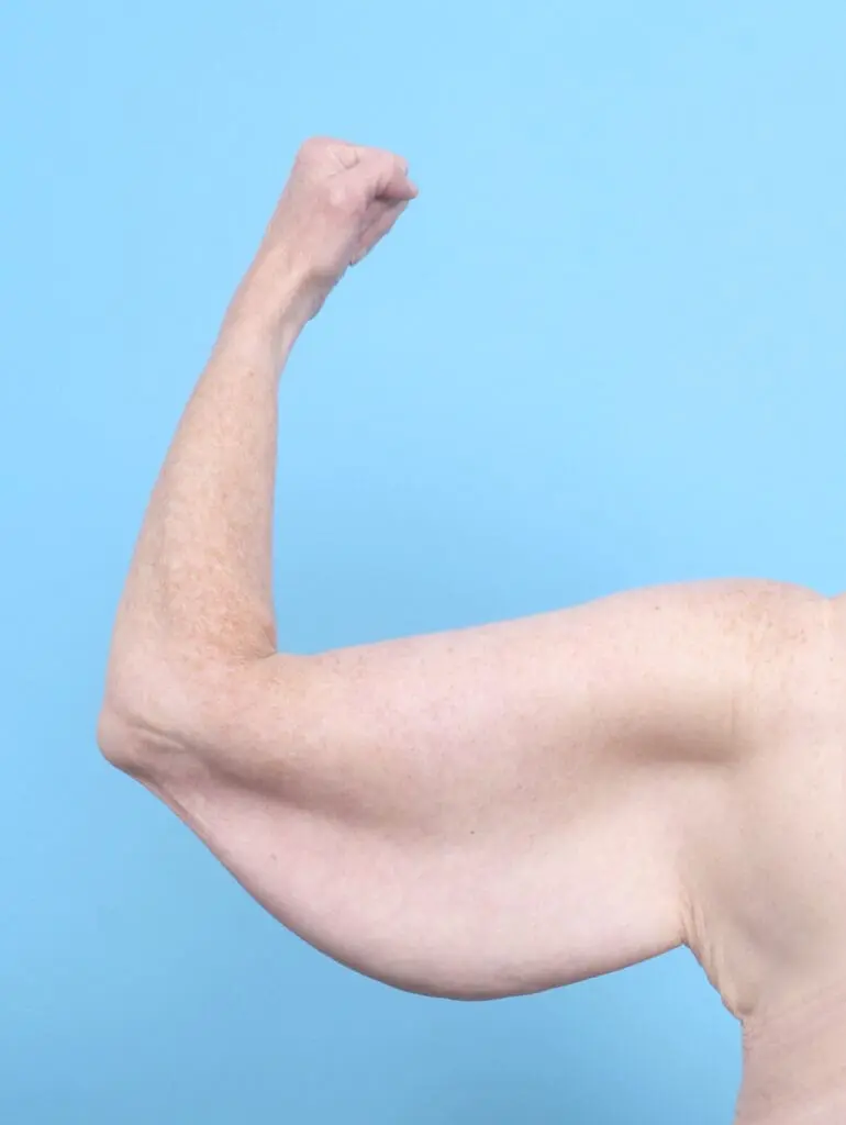 After Weight Loss - Case 55393 - Before