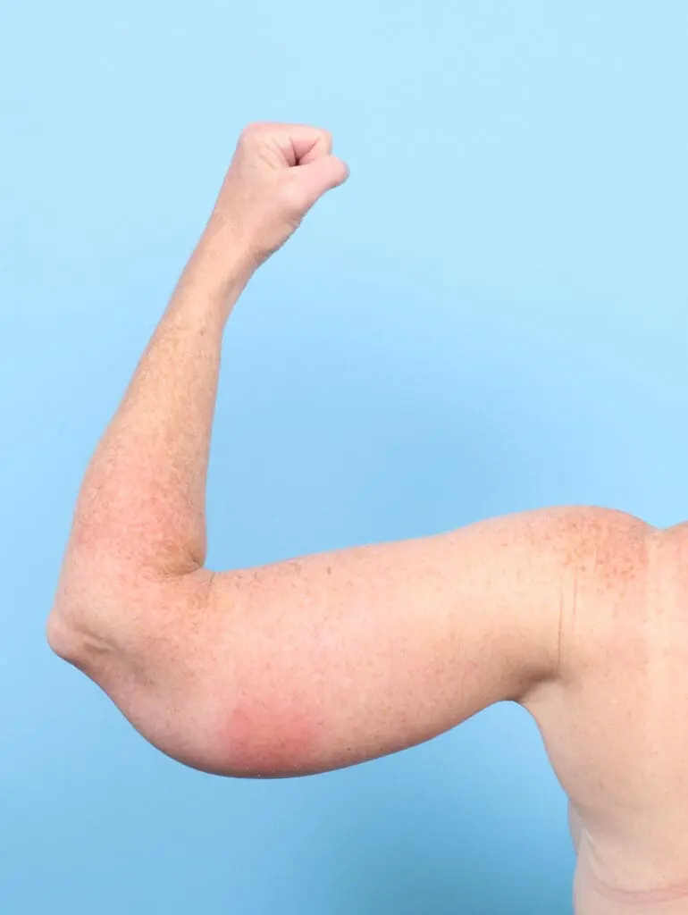 After Weight Loss - Case 55393 - After