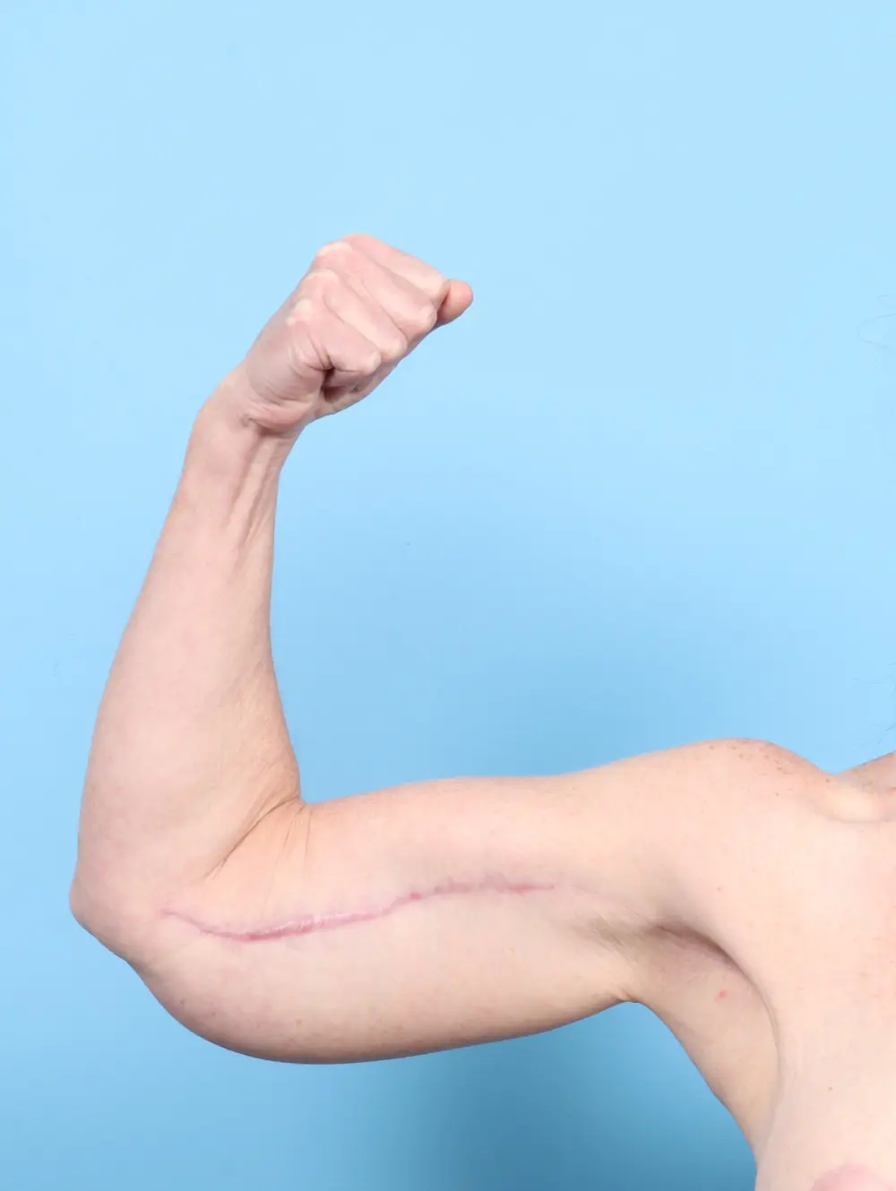 After Weight Loss Patient Photo - Case 55393 - after view-1