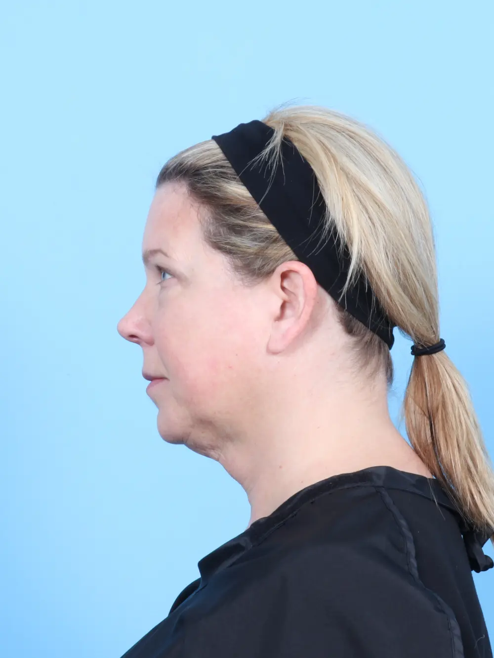 Bullhorn Lip Lift Patient Photo - Case 55407 - before view-2