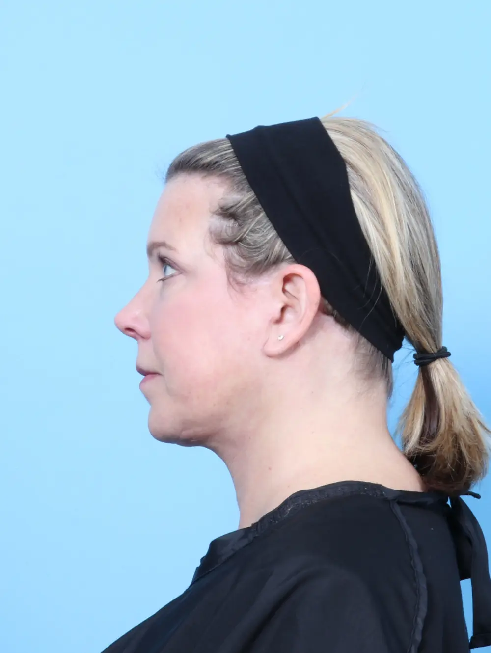 Bullhorn Lip Lift Patient Photo - Case 55407 - after view-2