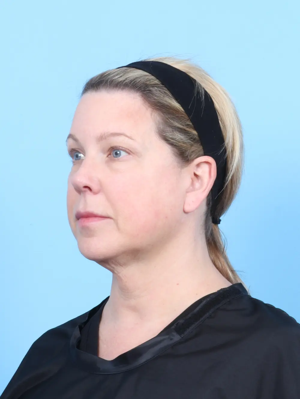 Bullhorn Lip Lift Patient Photo - Case 55407 - before view-1