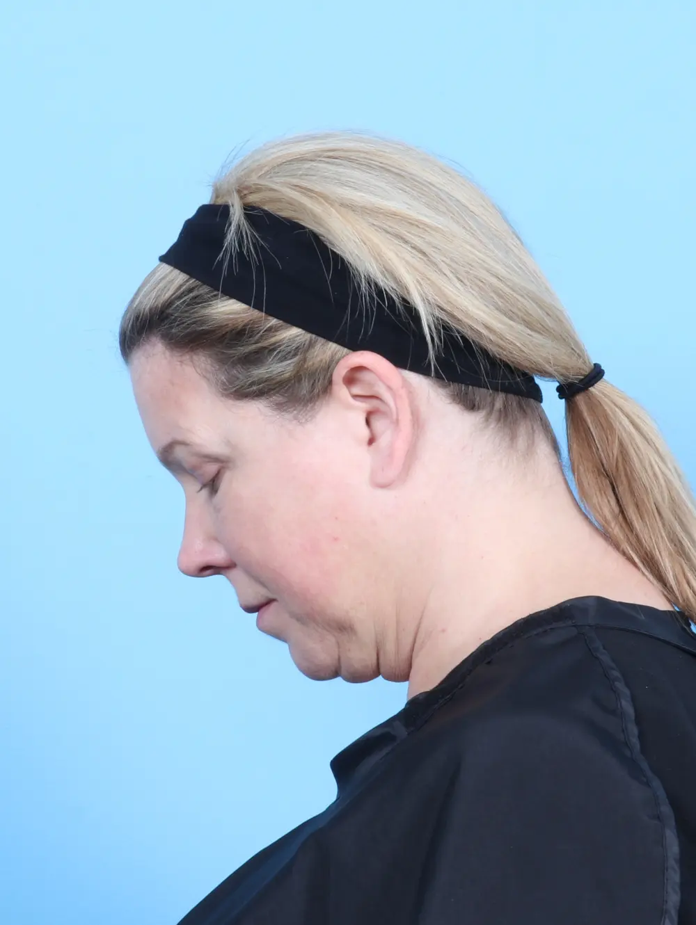 Bullhorn Lip Lift Patient Photo - Case 55407 - before view-3