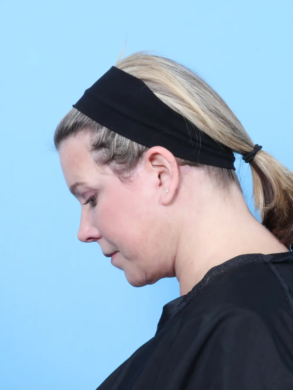 Bullhorn Lip Lift Patient Photo - Case 55407 - after view-3