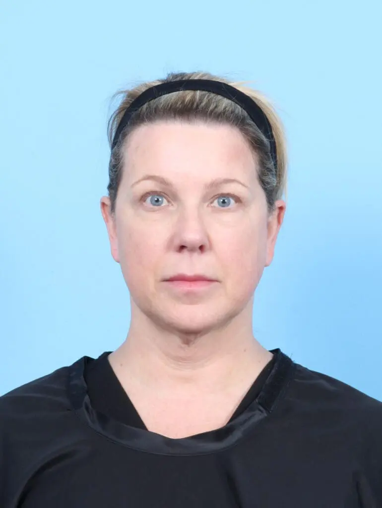 Bullhorn Lip Lift - Case 55407 - Before