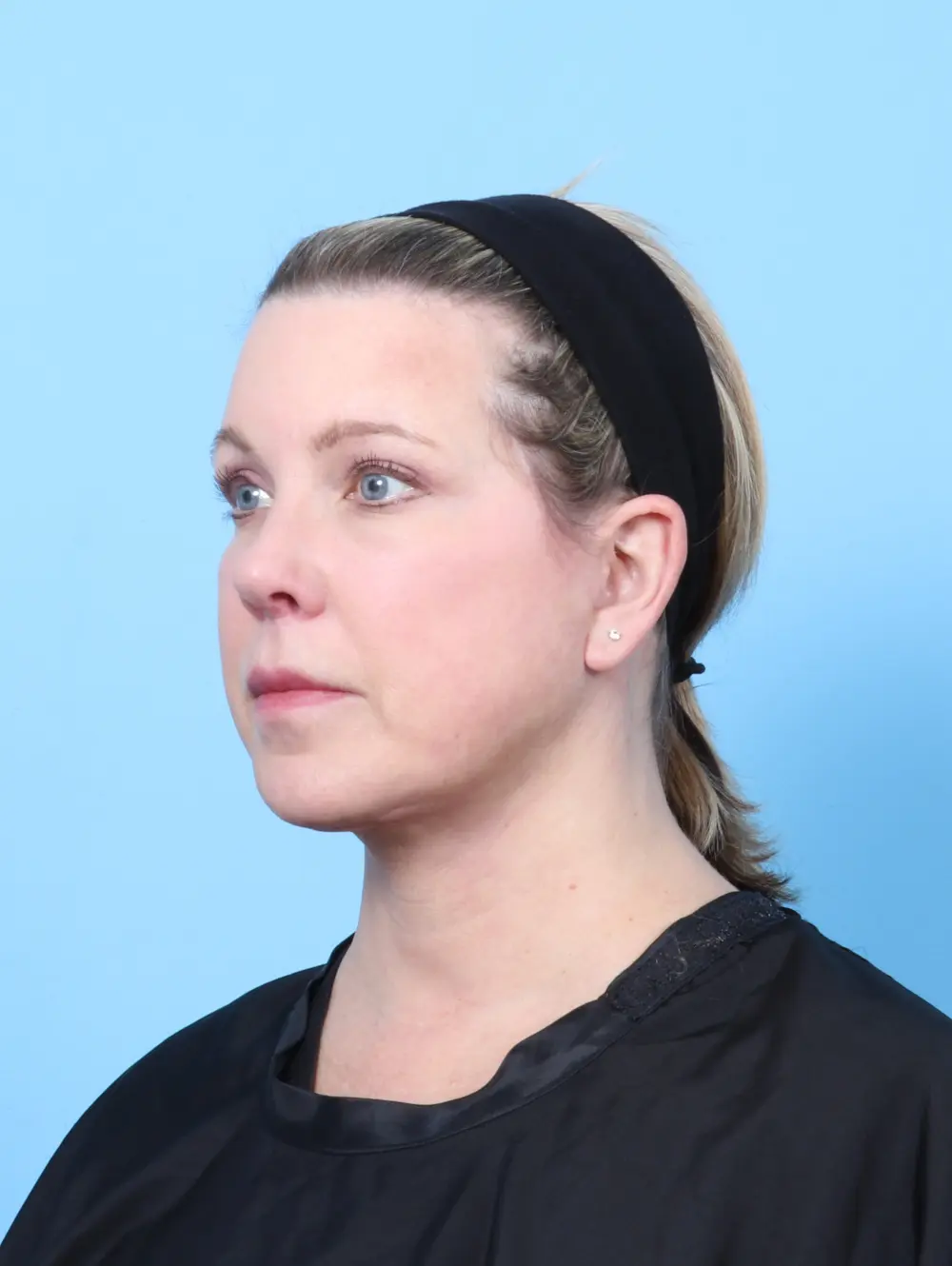 Bullhorn Lip Lift Patient Photo - Case 55407 - after view-1