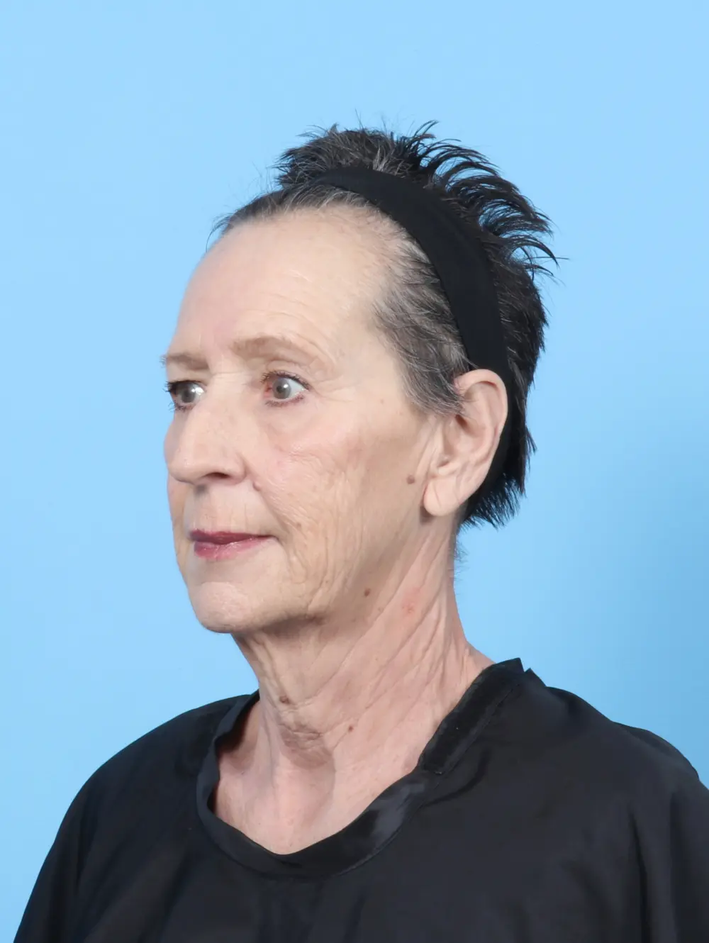 Facelift / Neck Lift Patient Photo - Case 55439 - before view-1