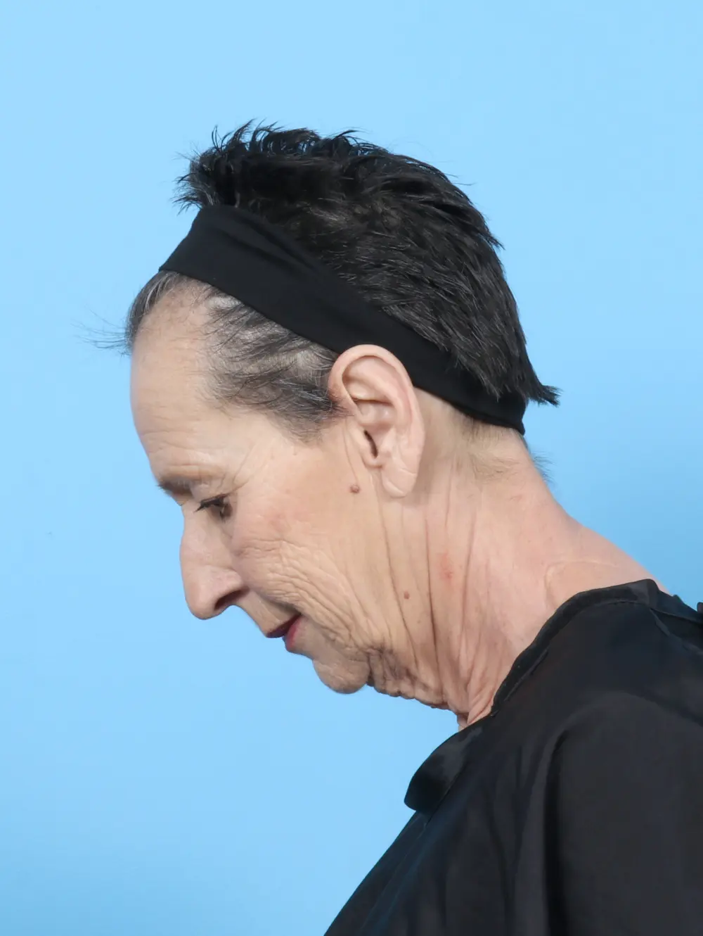 Facelift / Neck Lift Patient Photo - Case 55439 - before view-3