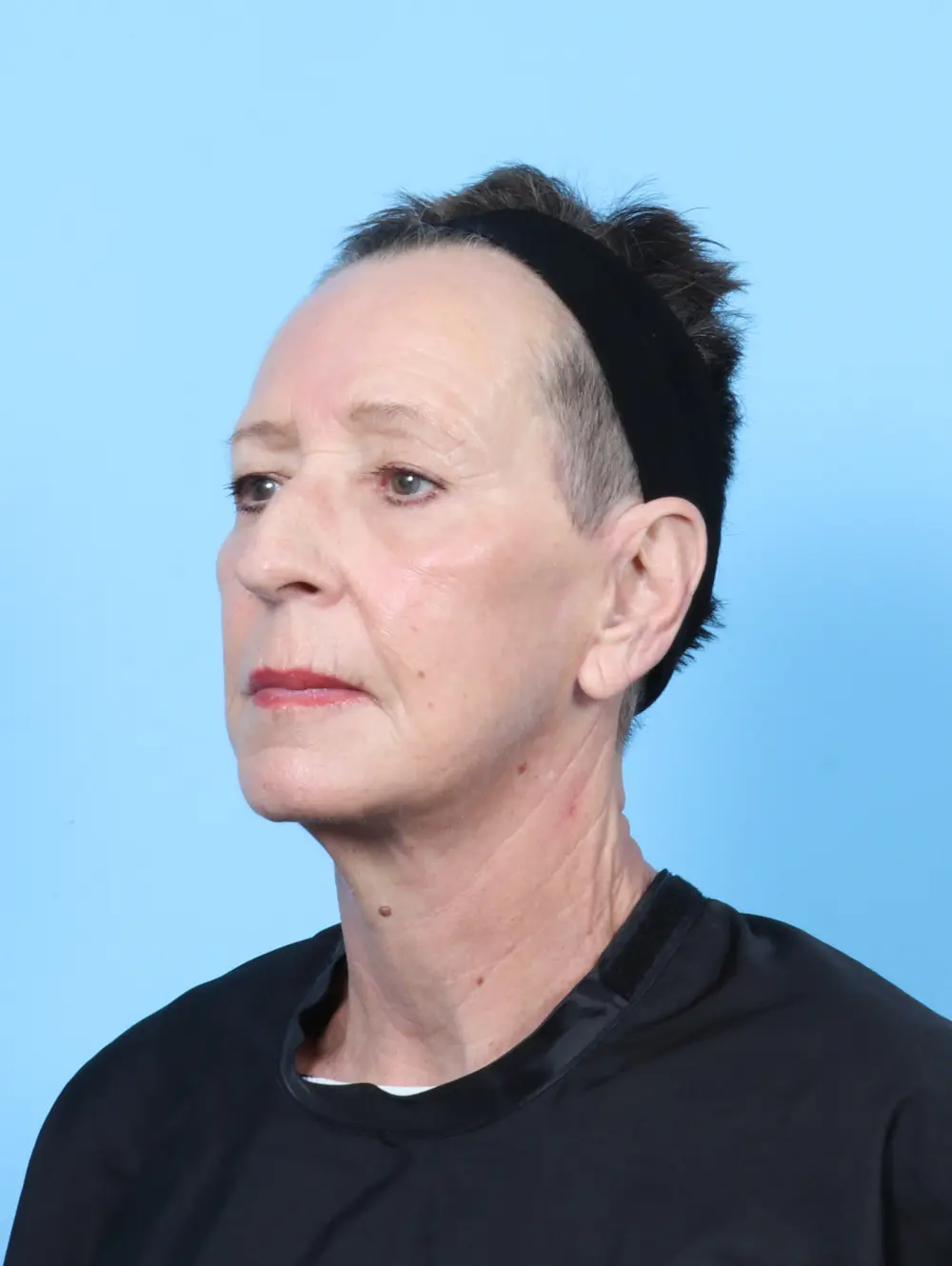 Facelift / Neck Lift Patient Photo - Case 55439 - after view-1