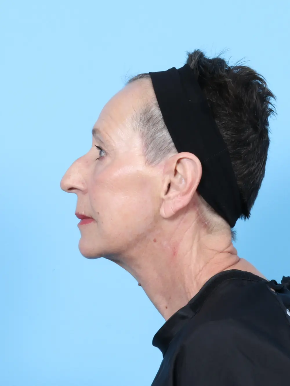 Facelift / Neck Lift Patient Photo - Case 55439 - after view-2