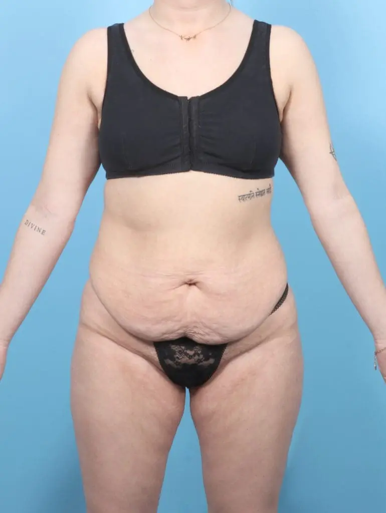 After Weight Loss - Case 55473 - Before