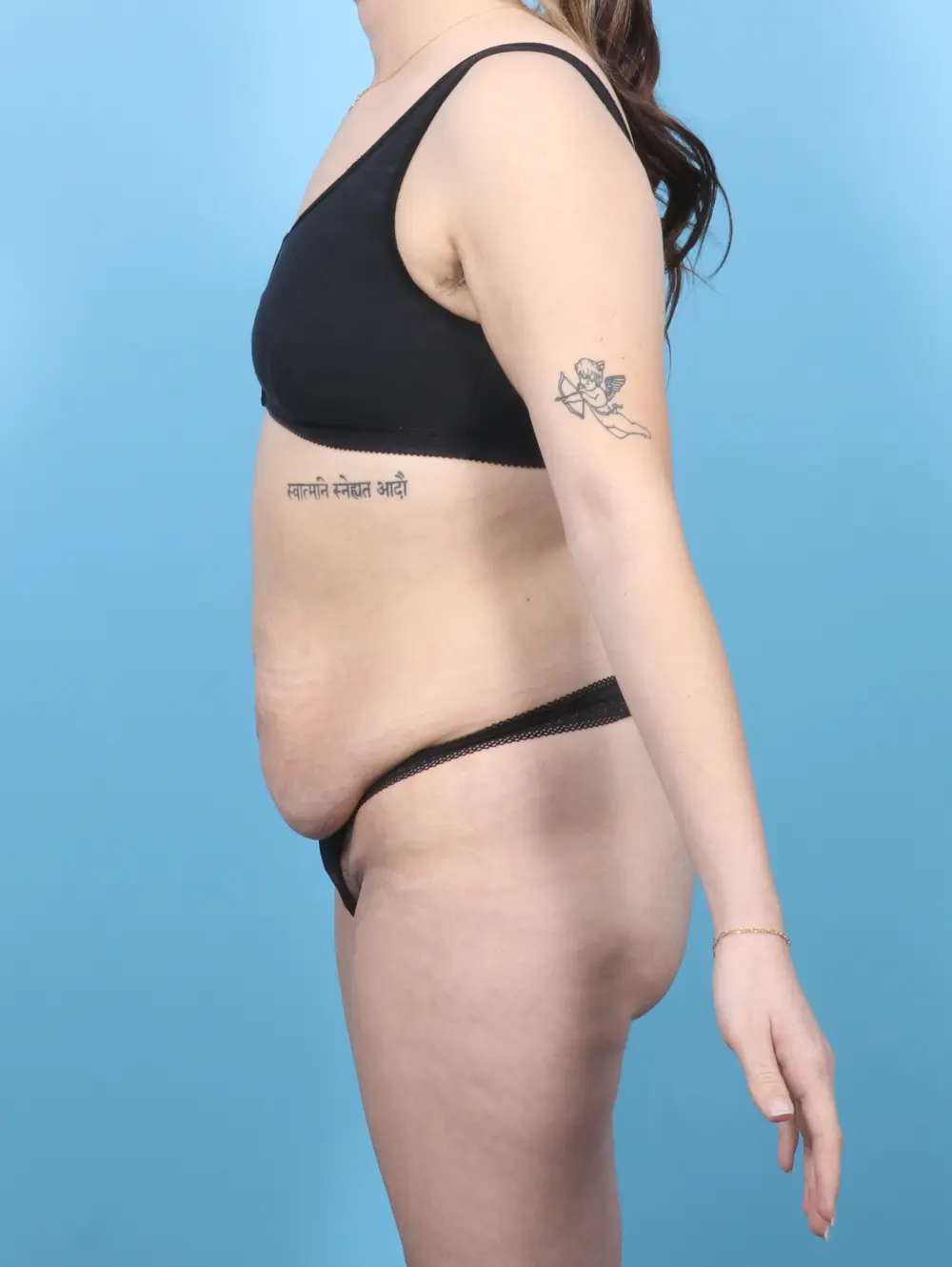 After Weight Loss Patient Photo - Case 55473 - before view-2