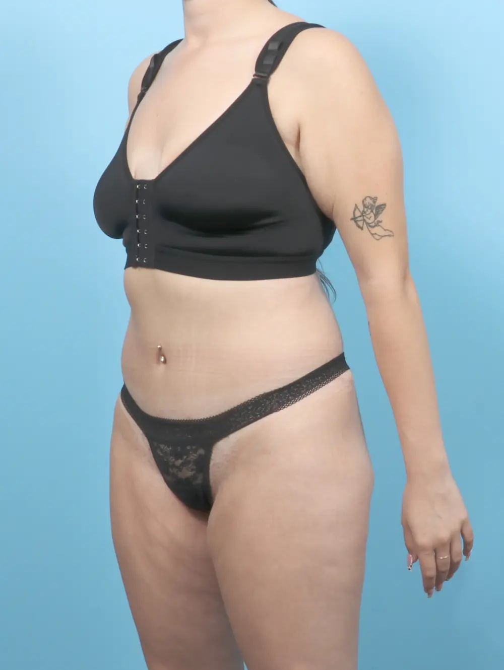 After Weight Loss Patient Photo - Case 55473 - after view-1