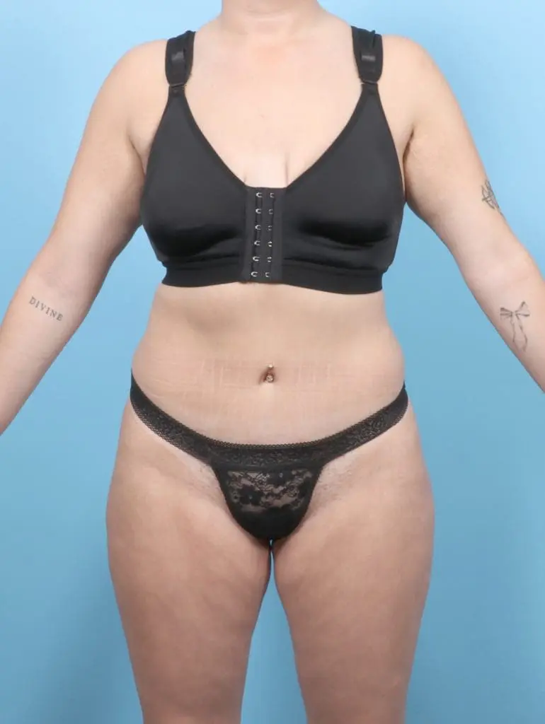 After Weight Loss - Case 55473 - After