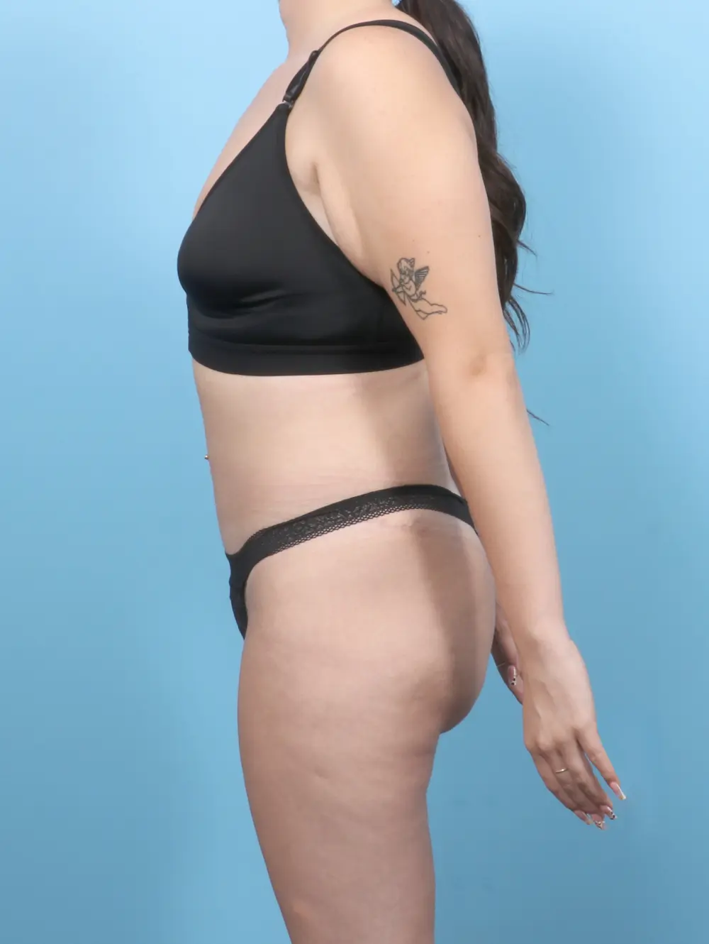 After Weight Loss Patient Photo - Case 55473 - after view-2