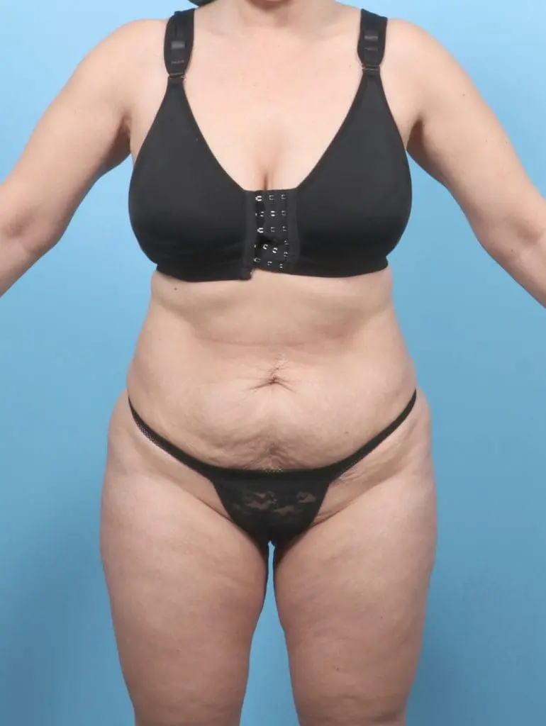 Tummy Tuck - Case 55495 - Before