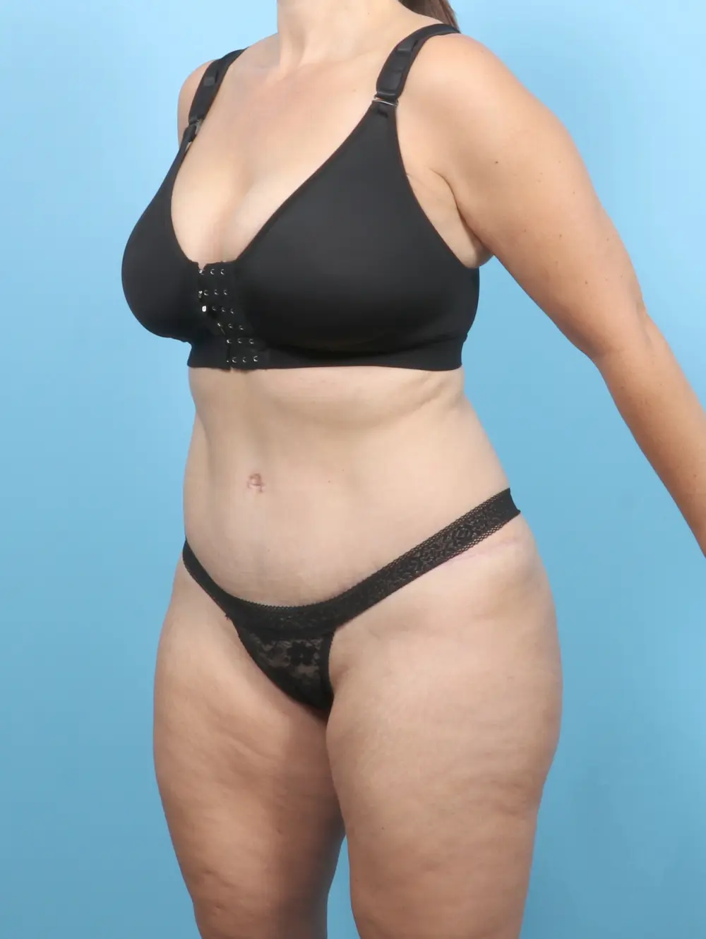 Tummy Tuck Patient Photo - Case 55495 - after view-1
