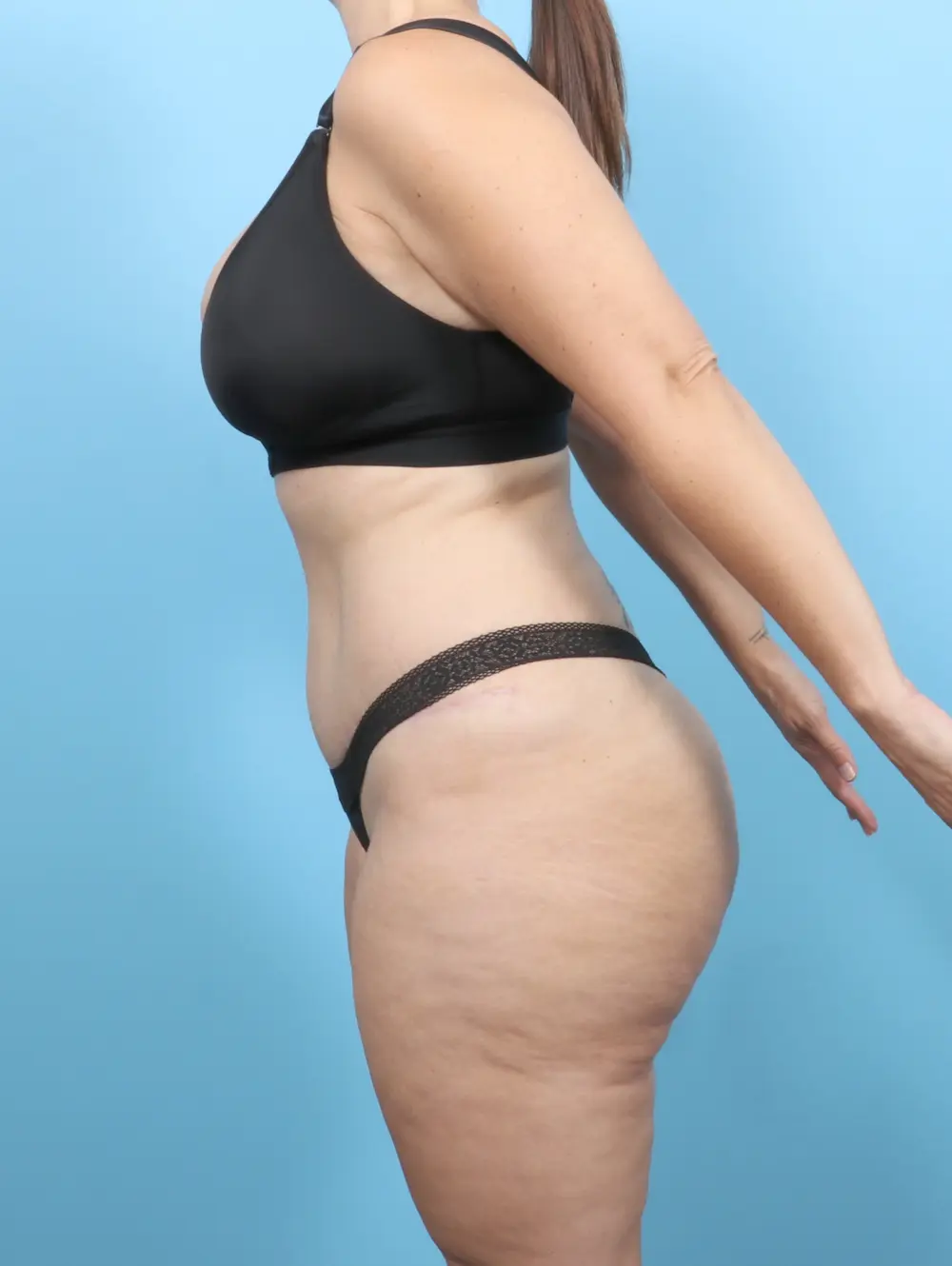 Tummy Tuck Patient Photo - Case 55495 - after view-2