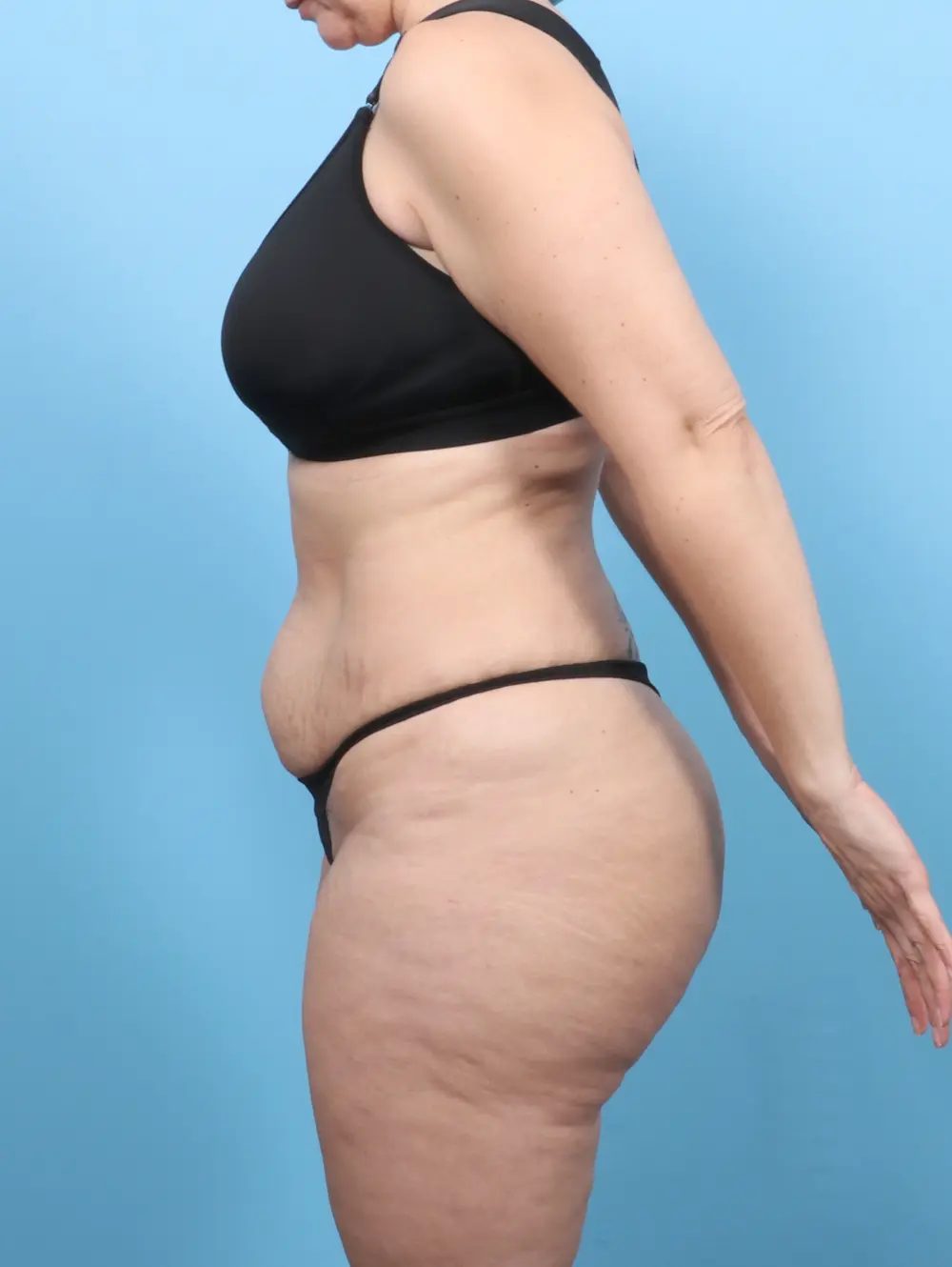 Tummy Tuck Patient Photo - Case 55495 - before view-2