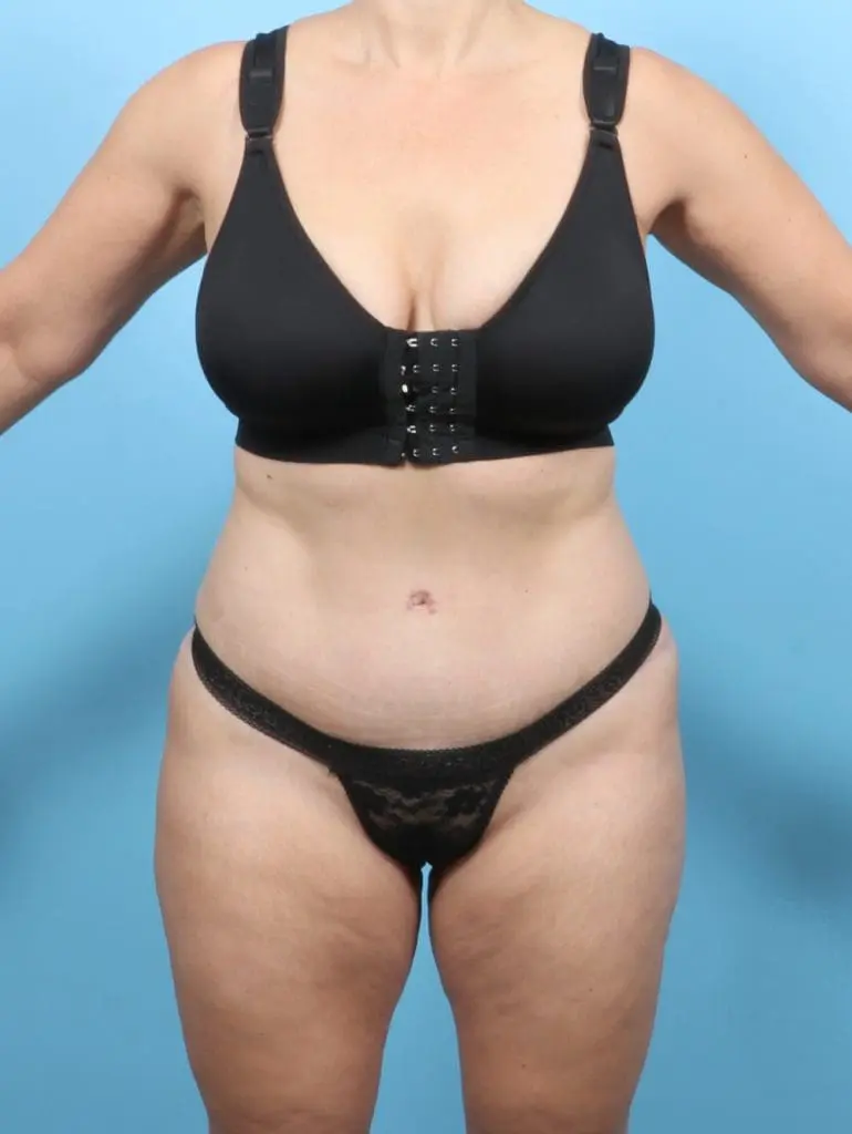 Tummy Tuck - Case 55495 - After