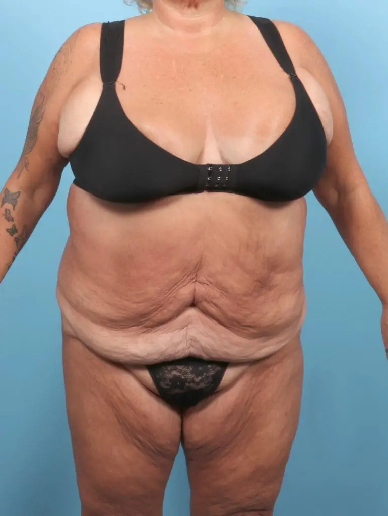 After Weight Loss - Case 55505 - Before