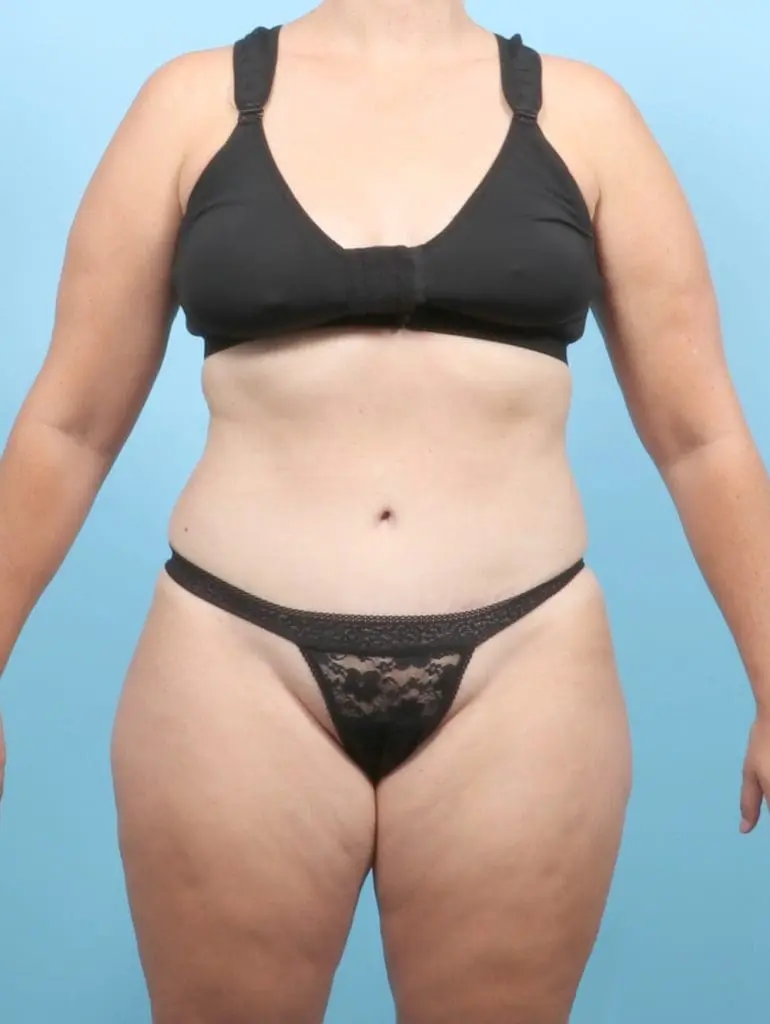 Tummy Tuck - Case 55525 - After