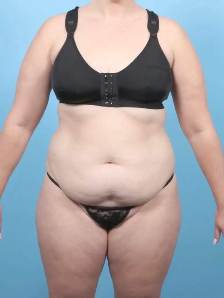 Tummy Tuck - Case 55525 - Before