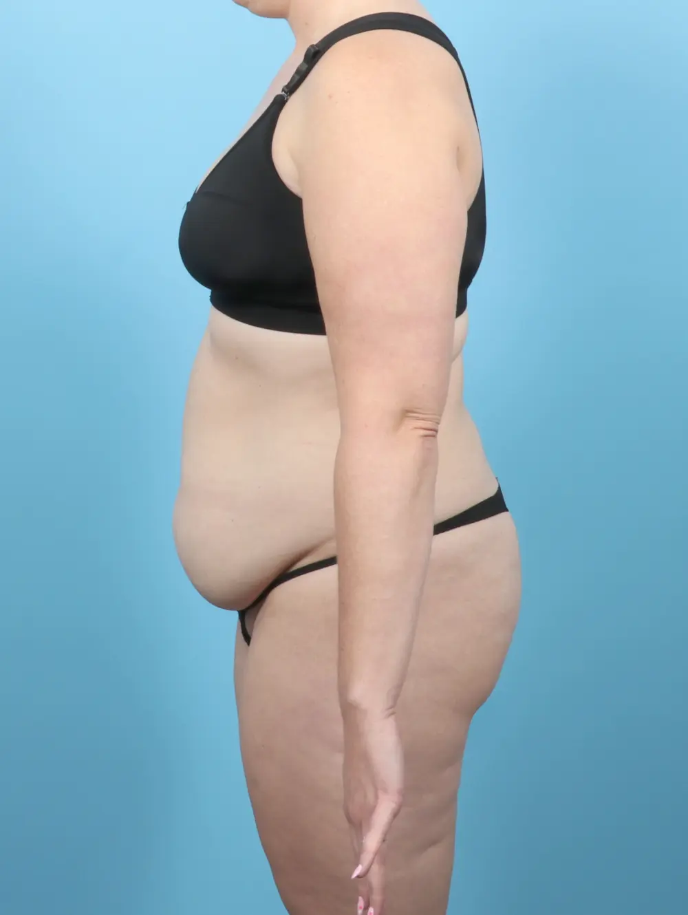 Tummy Tuck Patient Photo - Case 55525 - before view-2