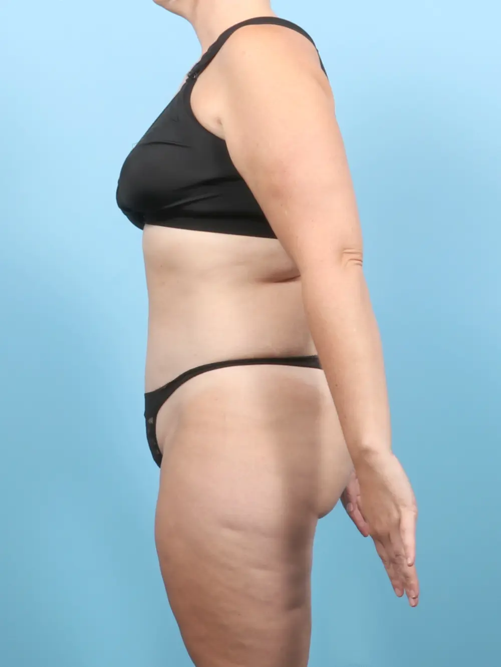 Tummy Tuck Patient Photo - Case 55525 - after view-2