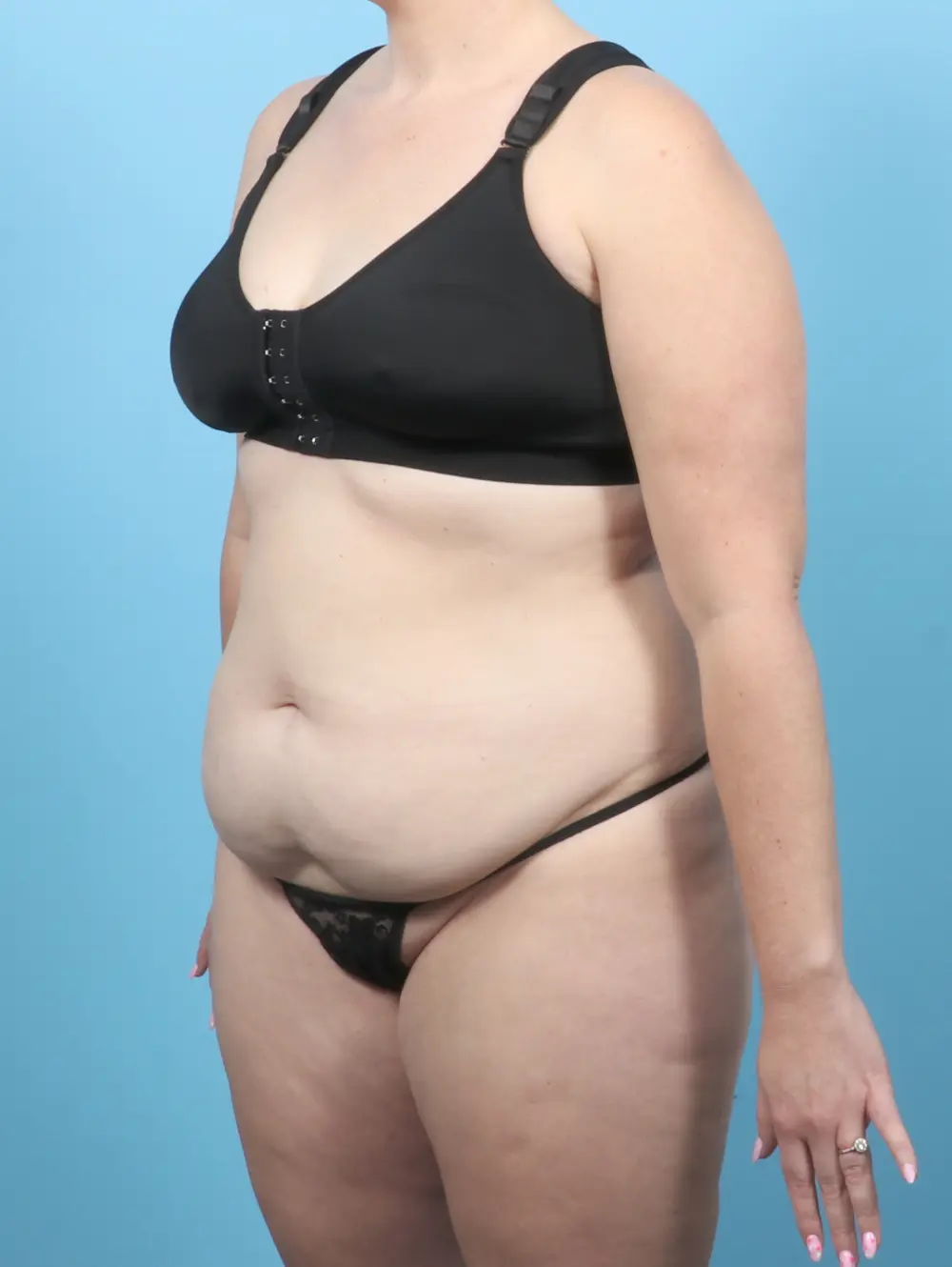 Tummy Tuck Patient Photo - Case 55525 - before view-1