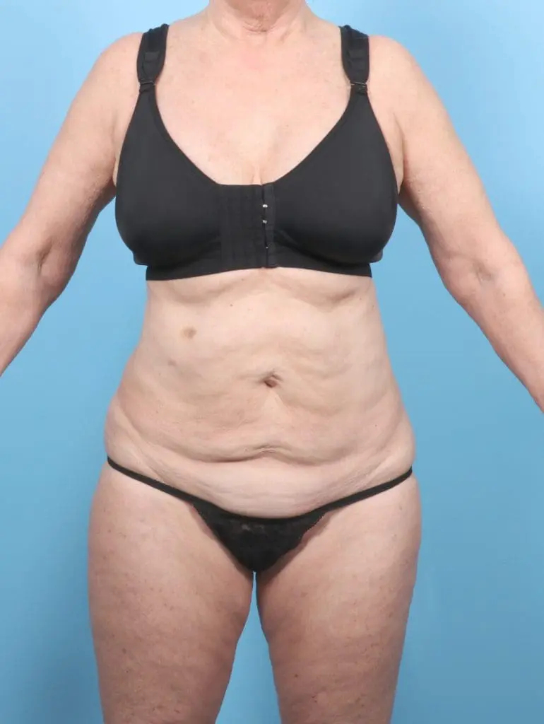 Tummy Tuck - Case 55541 - Before