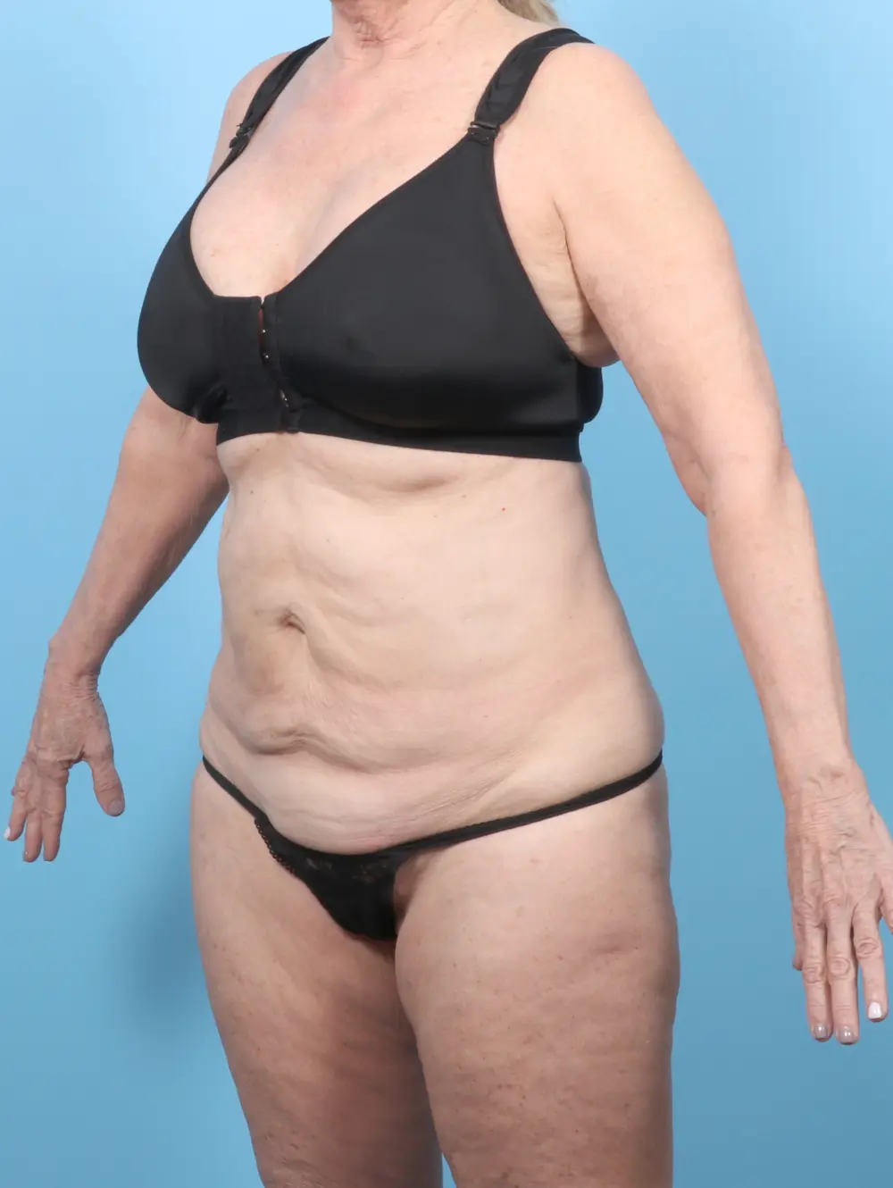 Tummy Tuck Patient Photo - Case 55541 - before view-1